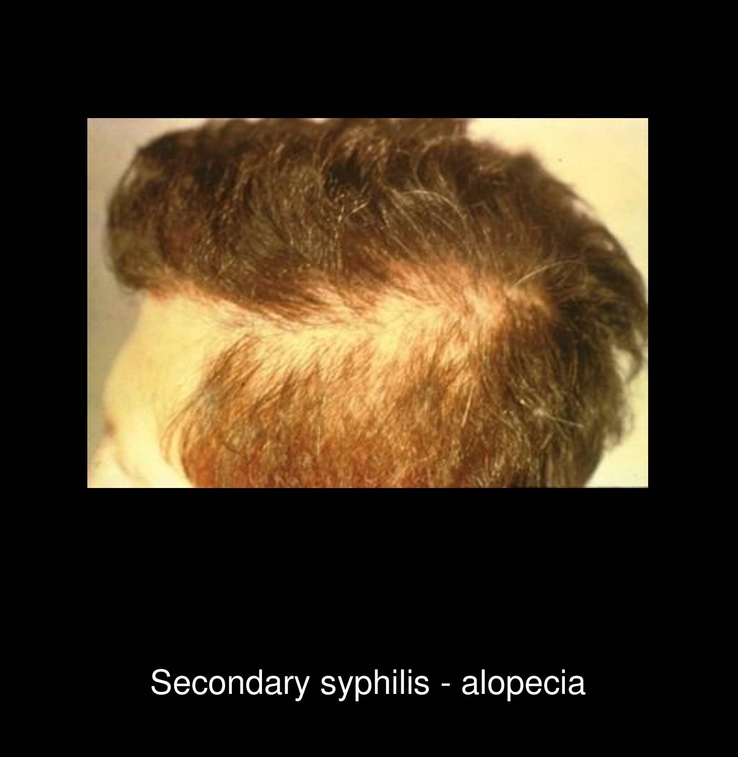 Congenital syphilis showing rhagades perioral fissures and scarring in infant with Treponema pallidum infection acquired from mother during pregnancy